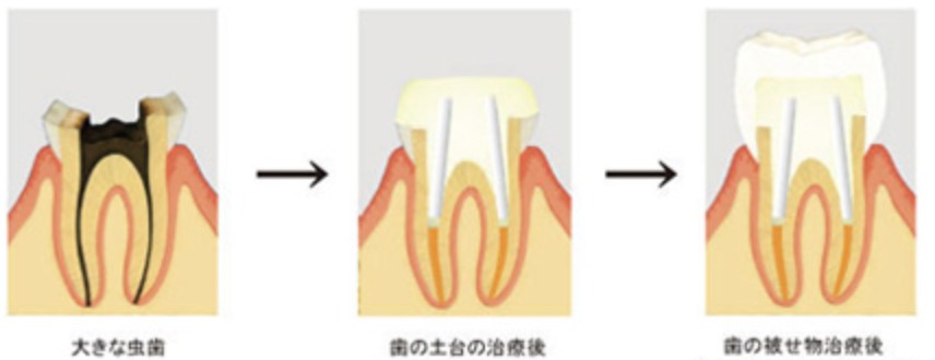 差し歯の土台について 画像