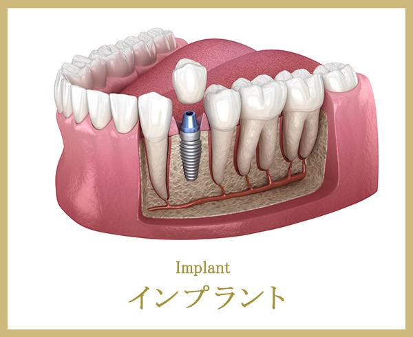 インプラントのイメージ画像