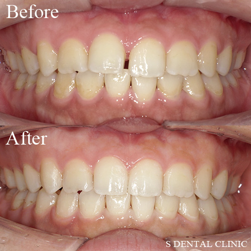 前歯の隙間をインビザラインで改善