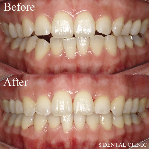 上下の歯の隙間をインビザラインで改善