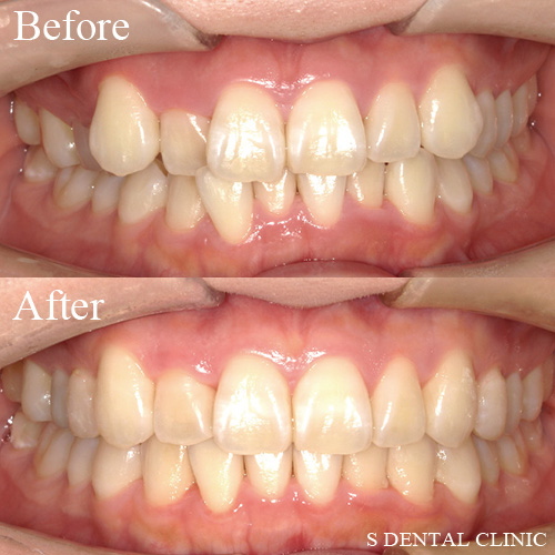 右上の八重歯と全顎的な噛み合わせの改善